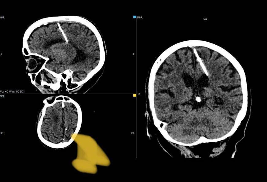 Иглу длиной в 3 сантиметра обнаружили в голове у 80-летней пациентки сахалинские рентгенологи