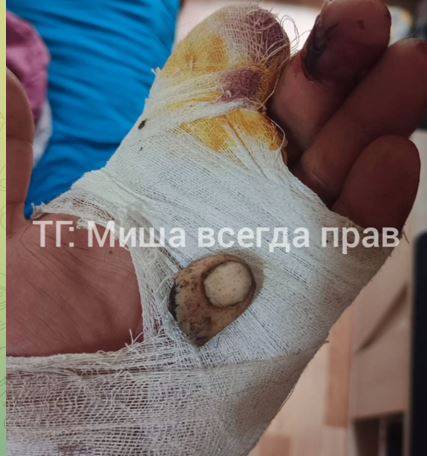 Прокуратура займется делом о членовредительстве