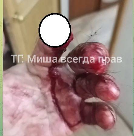 Житель Владивостока лишился пальца, пытаясь защитить свою собаку от бродячего пса