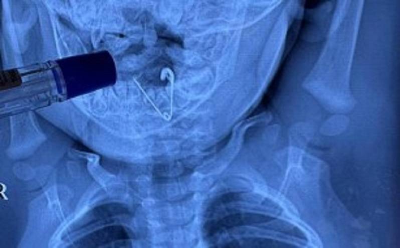 Раскрытую булавку-оберег проглотил младенец в Приморье Раскрытую булавку-оберег проглотил младенец в Приморье