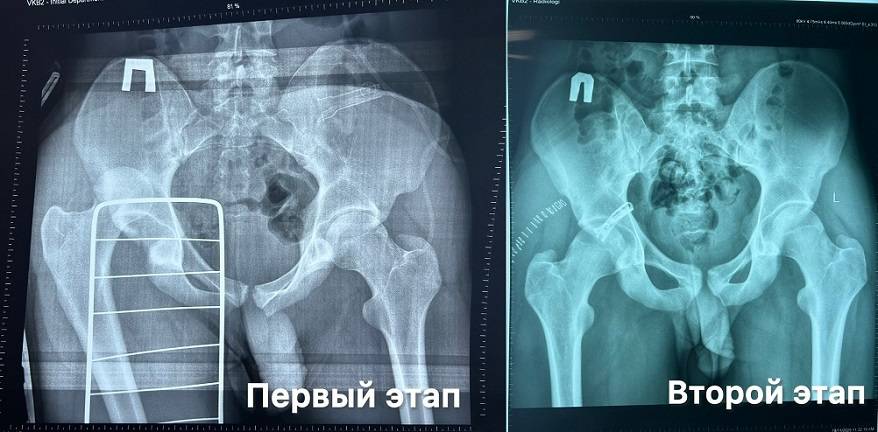 Шанс на полноценную жизнь дали врачи юному мопедисту, попавшему в ДТП в Приморье