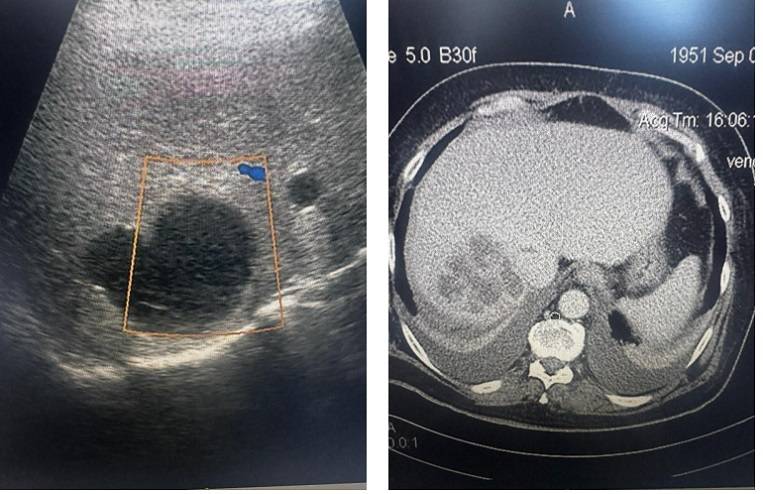 Огромную опухоль удалили из тела жителя Владивостока