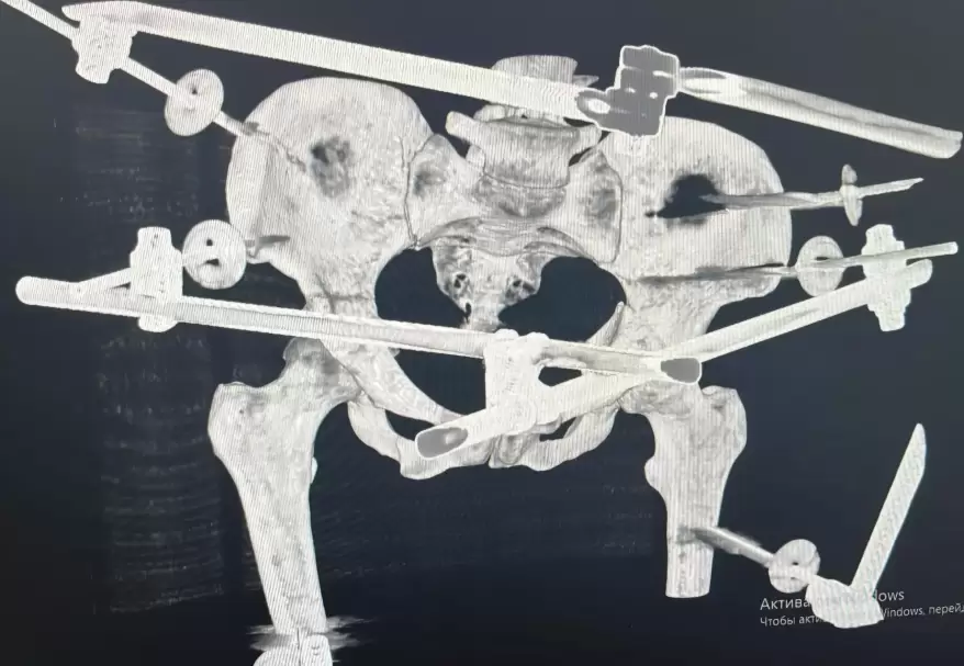 Врачи собрали по косточкам молодую девушку, попавшую в страшное ДТП в Приморье