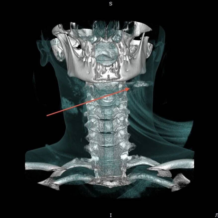 Во Владивостоке врачи спасли жизнь подростка с тяжелым пулевым ранением шеи
