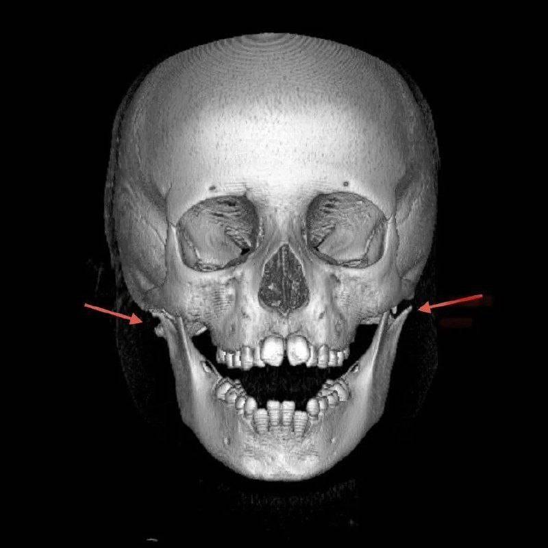 6-летний мальчик сломал челюсть, столкнувшись на снежной горке со сверстником в Приморье