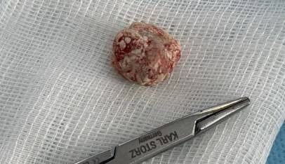 Приморец в течение 17 лет «растил» камень в своем теле