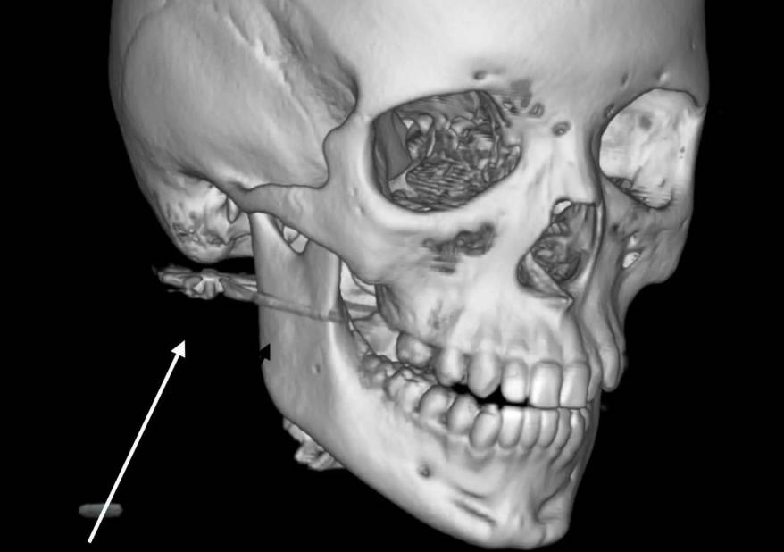 Пуля попала в лицо мальчику в Приморье
