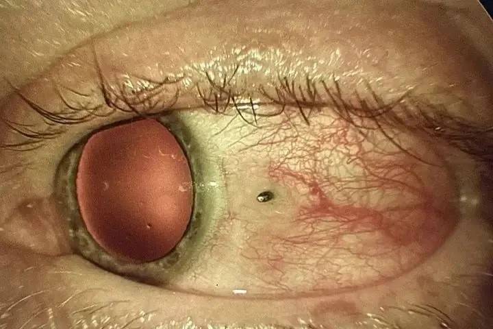 Кусок металла вонзился в глаз жителю Приморья